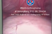 Bệnh viện Hùng Vương nội soi thành công ca u quái khổng lồ ở bé gái 14 tuổi