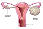 Chẩn đoán và điều trị ung thư buồng trứng