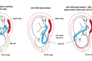 Dây rốn lạc chỗ