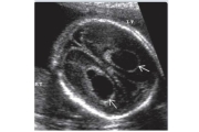 Nang đám rối mạch mạc (Choroid Plexus Cyst)