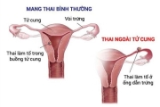 Thai ngoài tử cung 