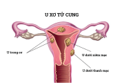 U xơ – Cơ tử cung