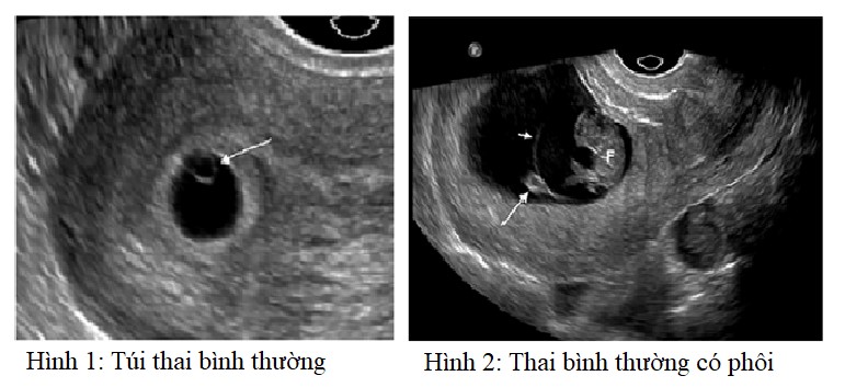 Siêu âm chẩn đoán “Chảy máu ba tháng đầu thai kỳ” - Bệnh viện Hùng ...